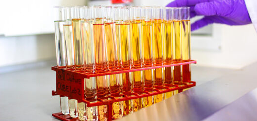 Urine test could help detect lung cancer years before symptoms occur