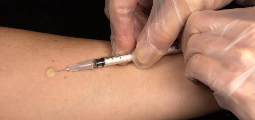 vaccination, tuberculin test, injection, splash, doctor, medicine, diagnosis, tuberculosis, disease, flu vaccination, immune system, vaccination, injection, tuberculosis, tuberculosis, tuberculosis, tuberculosis, tuberculosis
